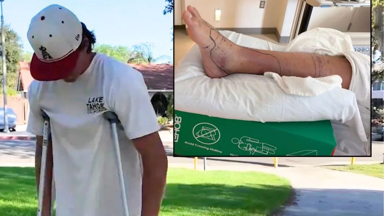 College Athlete Hospitalized After Rattlesnake Bite on California Hiking Trail Required 34 Doses of Antivenom
