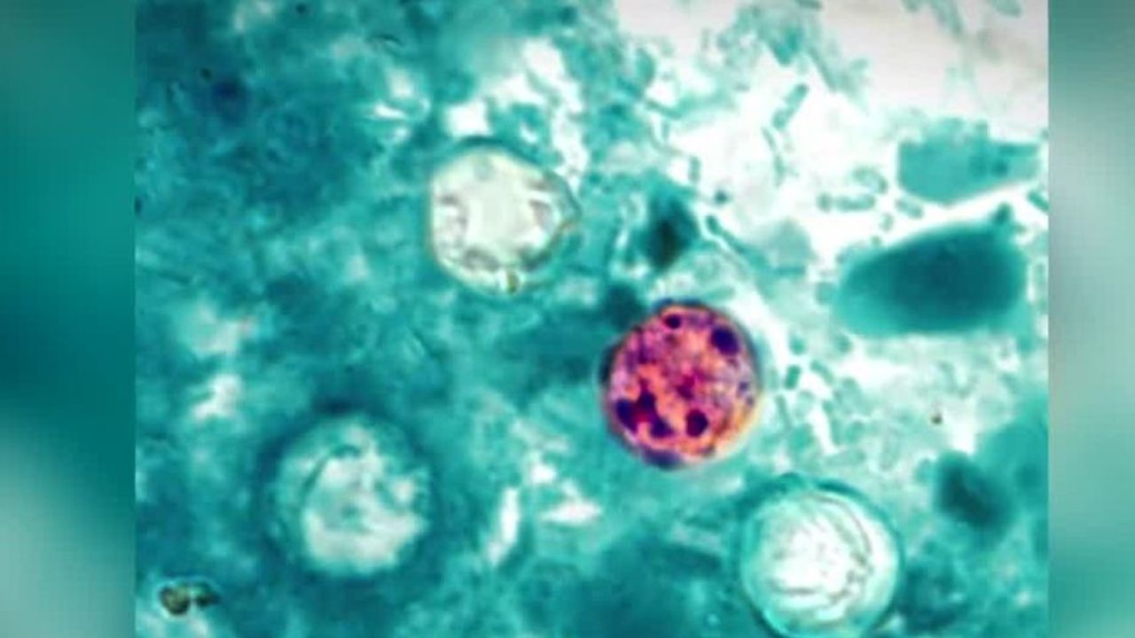 Health Alert Diarrhea-Causing Parasite Spreads Across Florida, Miami-Dade Hit Hardest