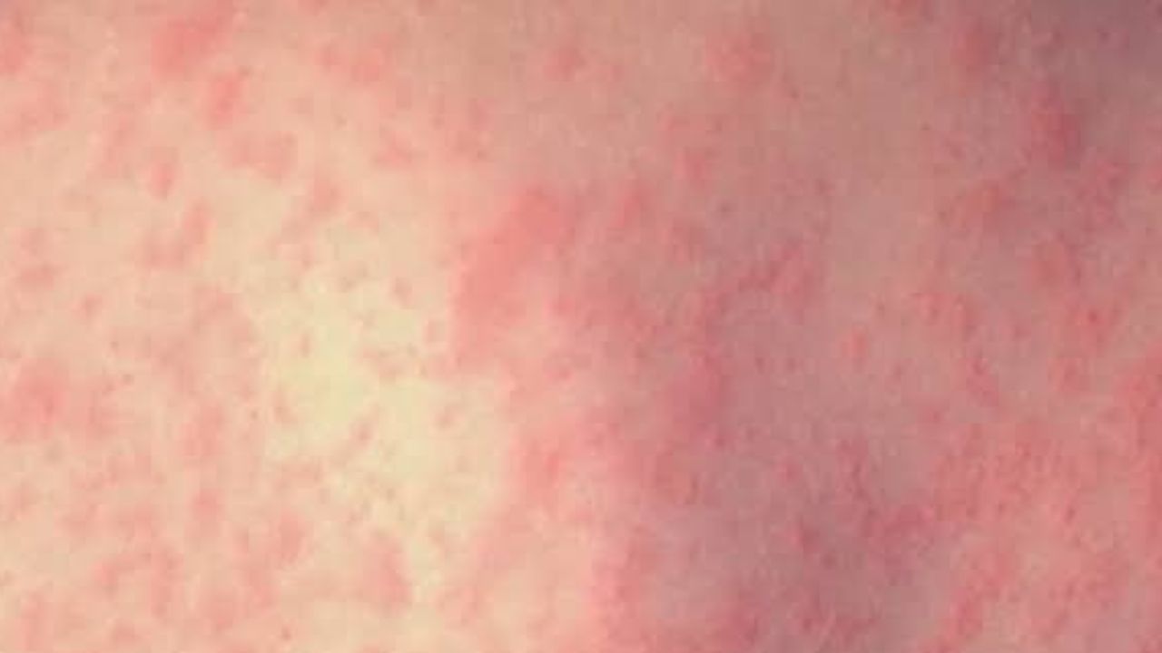 Measles Outbreak Confirmed in Delaware as Case Count Rises—Health Officials Urge Residents to Check Vaccination Status