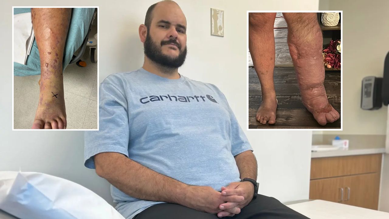 Florida Man's Leg Swelled to 8 Times Its Size After Bacteria Entered Through a Small Wound, Leaving Him Facing Amputation